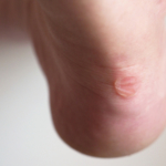 Skavsår på fötterna: orsaker, behandling & förebyggande åtgärder